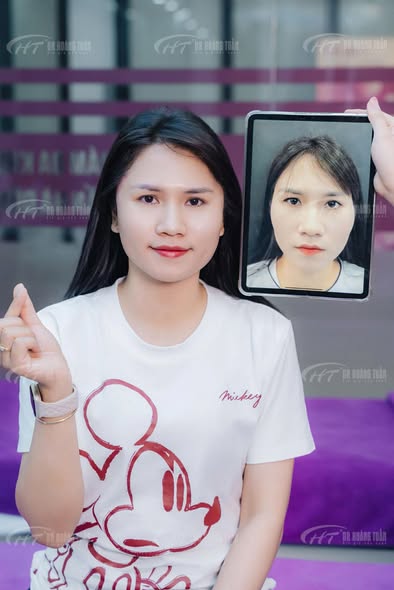 độn thái dương có biến chứng không