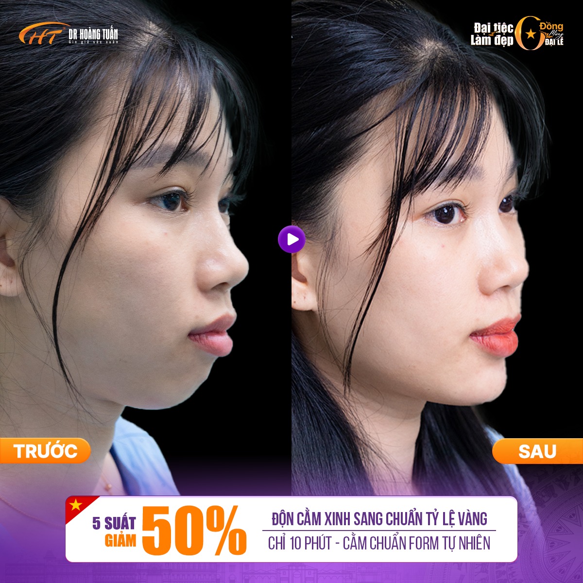 độn cằm c&oacute; hết h&ocirc; kh&ocirc;ng