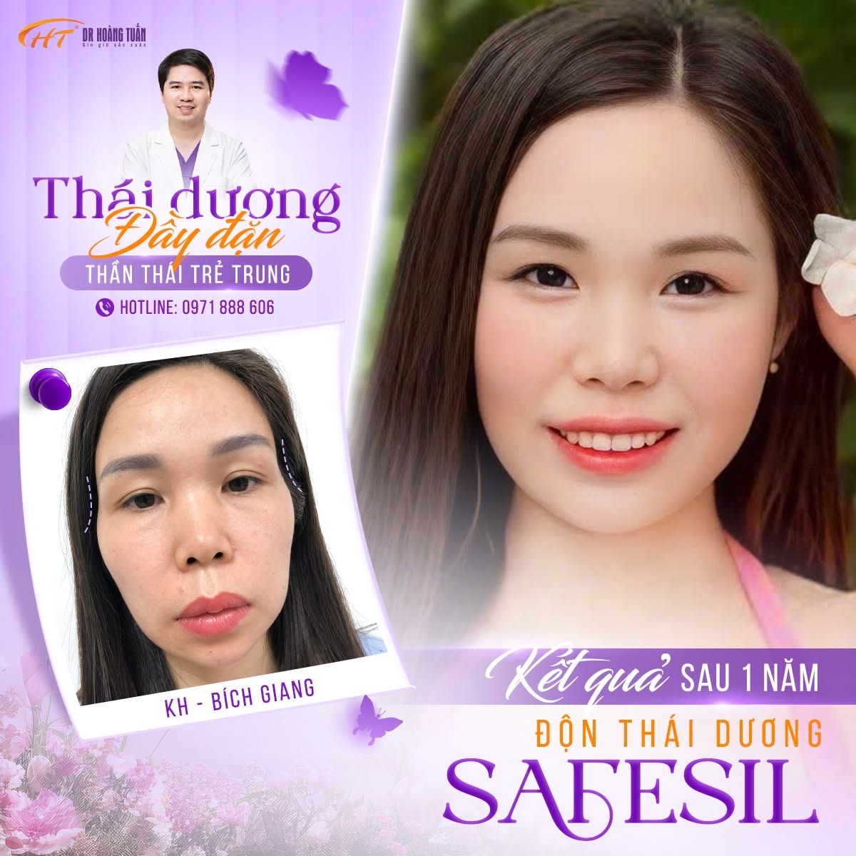 sụn độn th&aacute;i dương