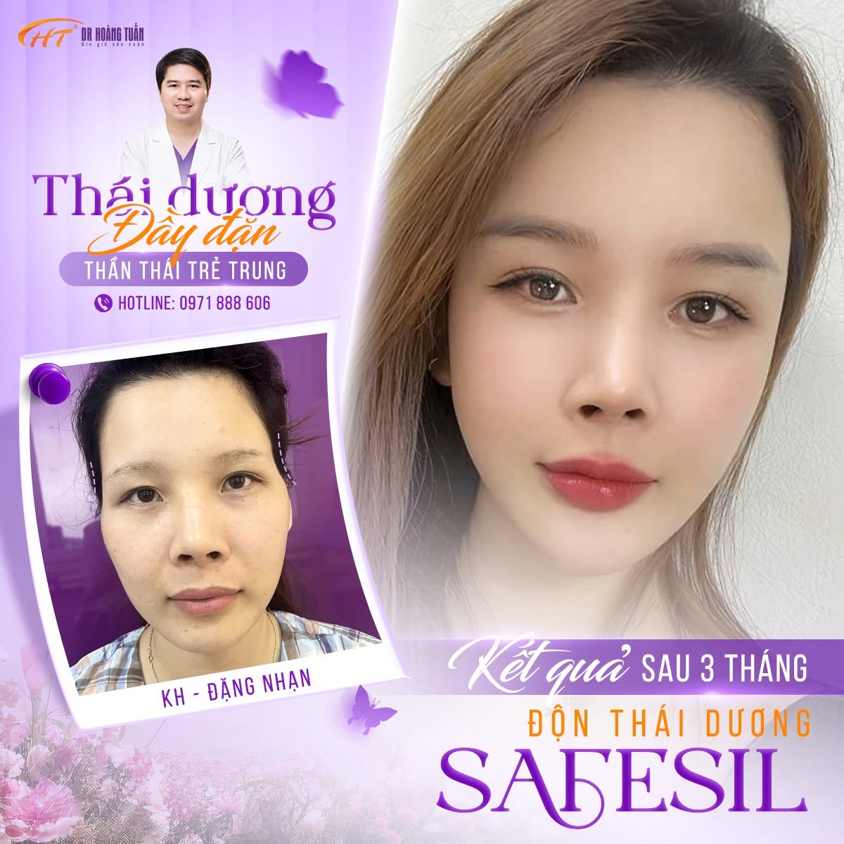 sụn độn th&aacute;i dương