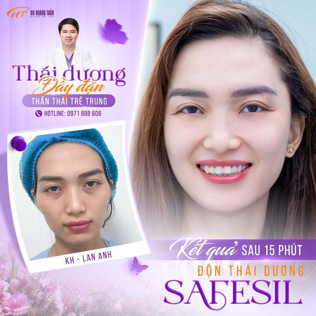 sụn độn th&aacute;i dương
