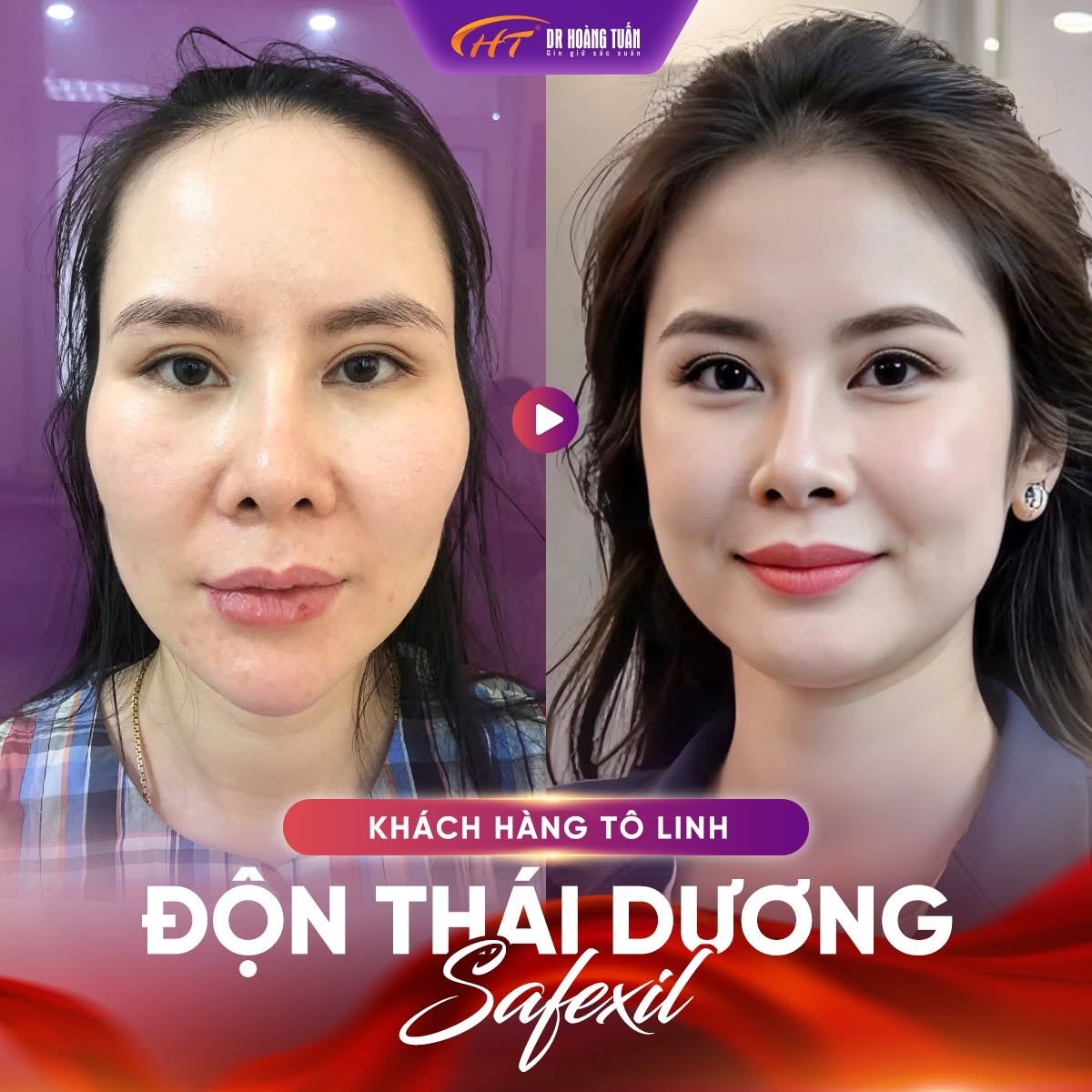 độn th&aacute;i dương bị lệch
