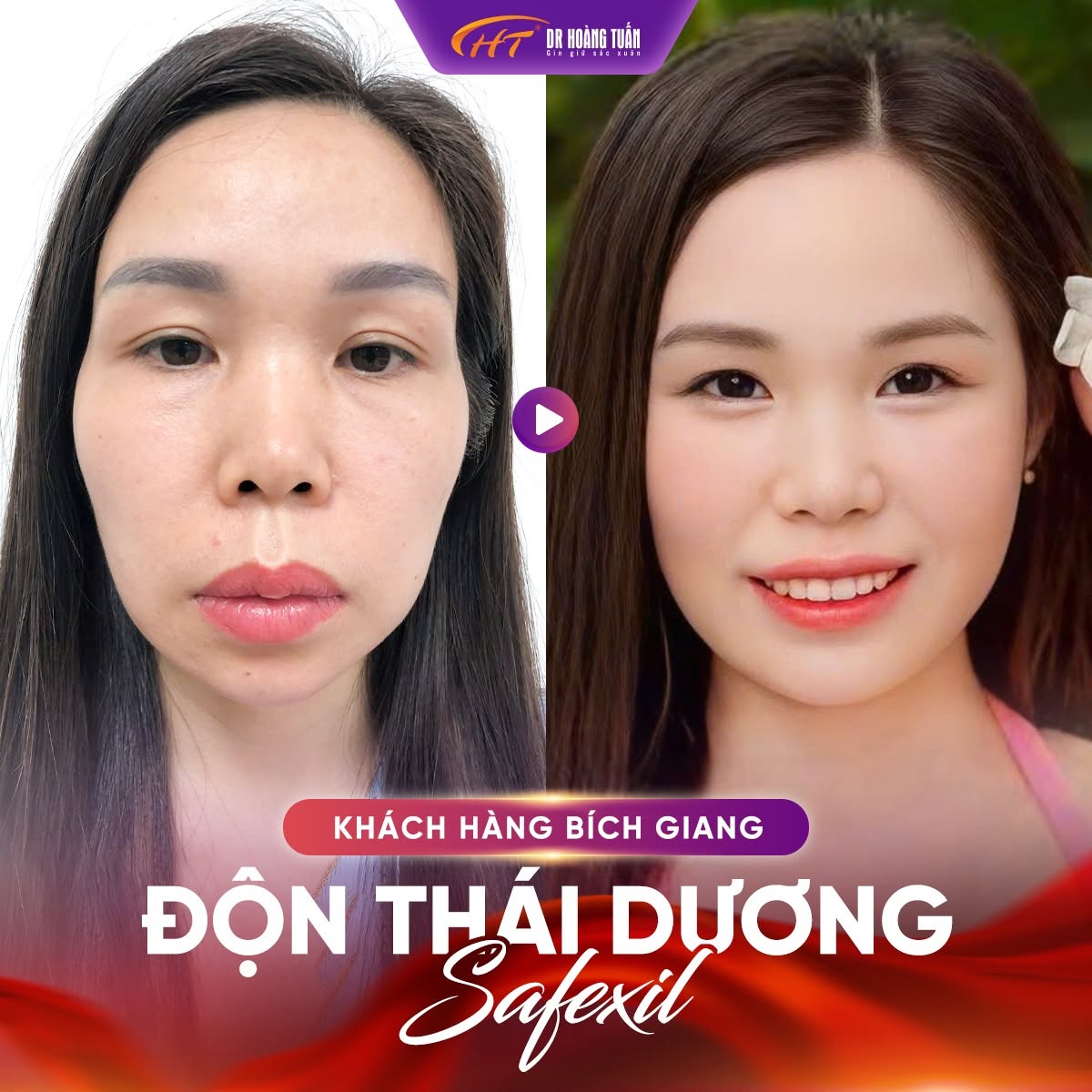 độn th&aacute;i dương bị lệch