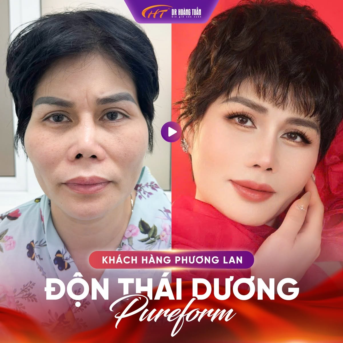 độn th&aacute;i dương bị lệch