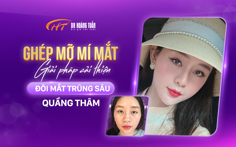 các phương pháp phẫu thuật thẩm mỹ mắt