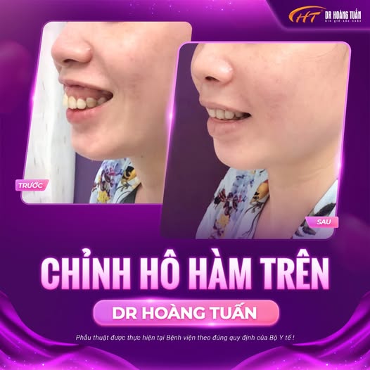 phẫu thuật hàm hô