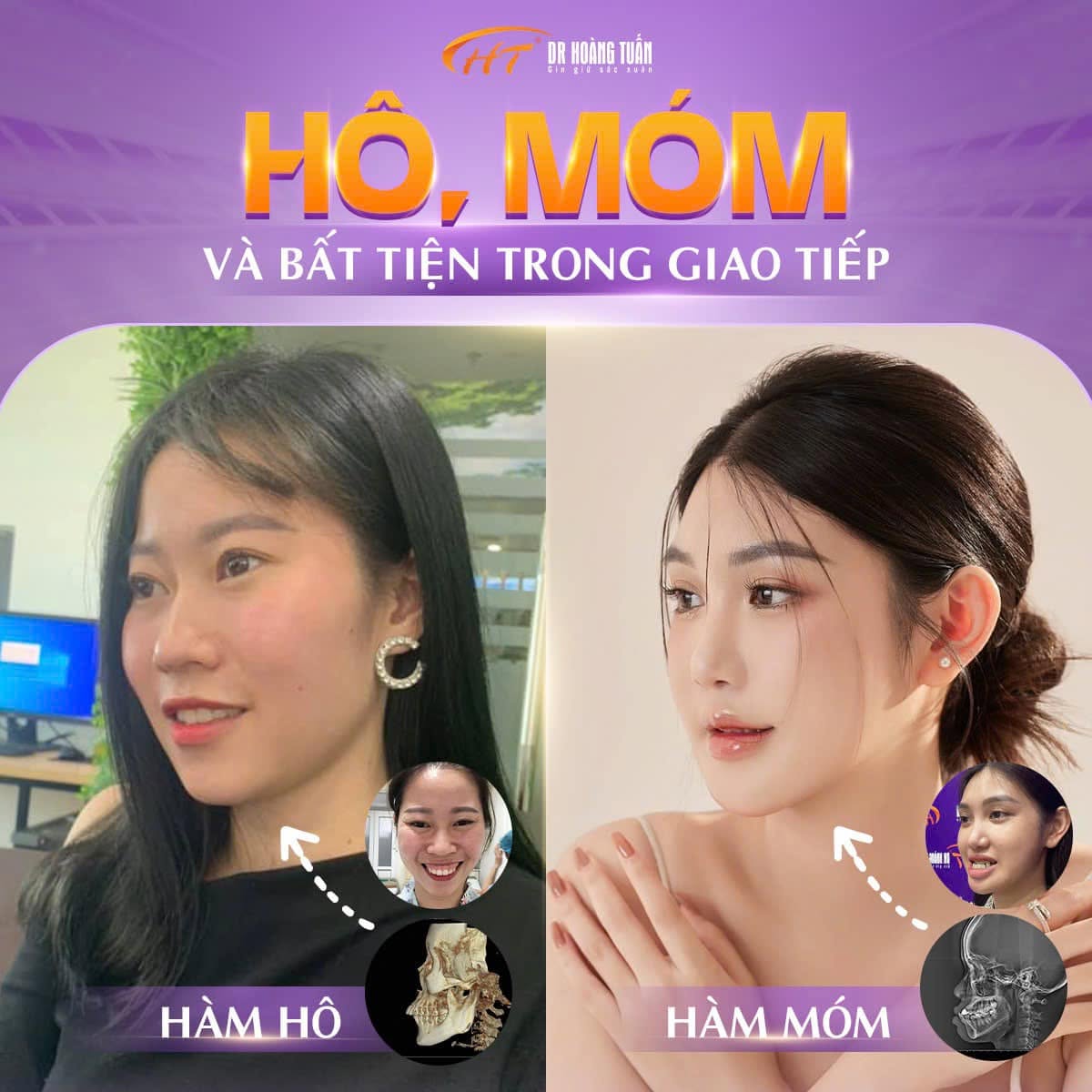 phẫu thuật hàm hô