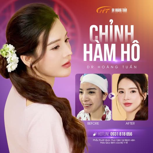 phẫu thuật hàm hô
