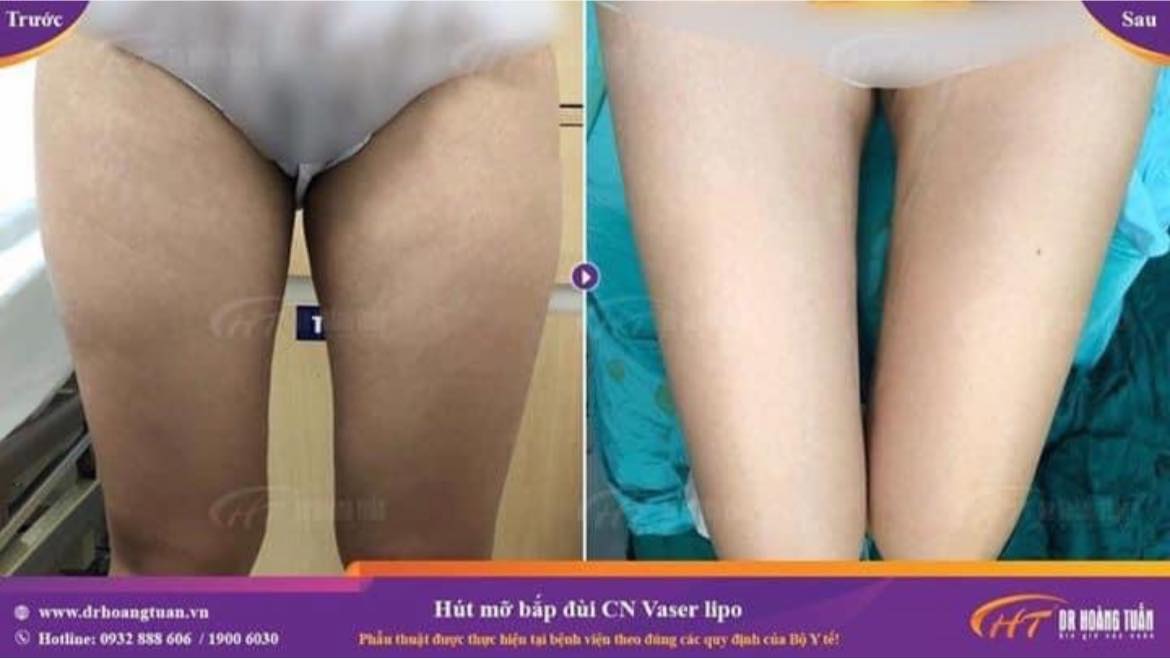 Hút mỡ bắp chân