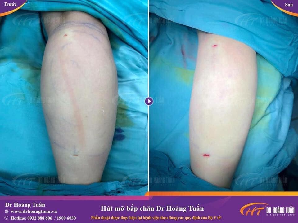 Hút mỡ bắp chân