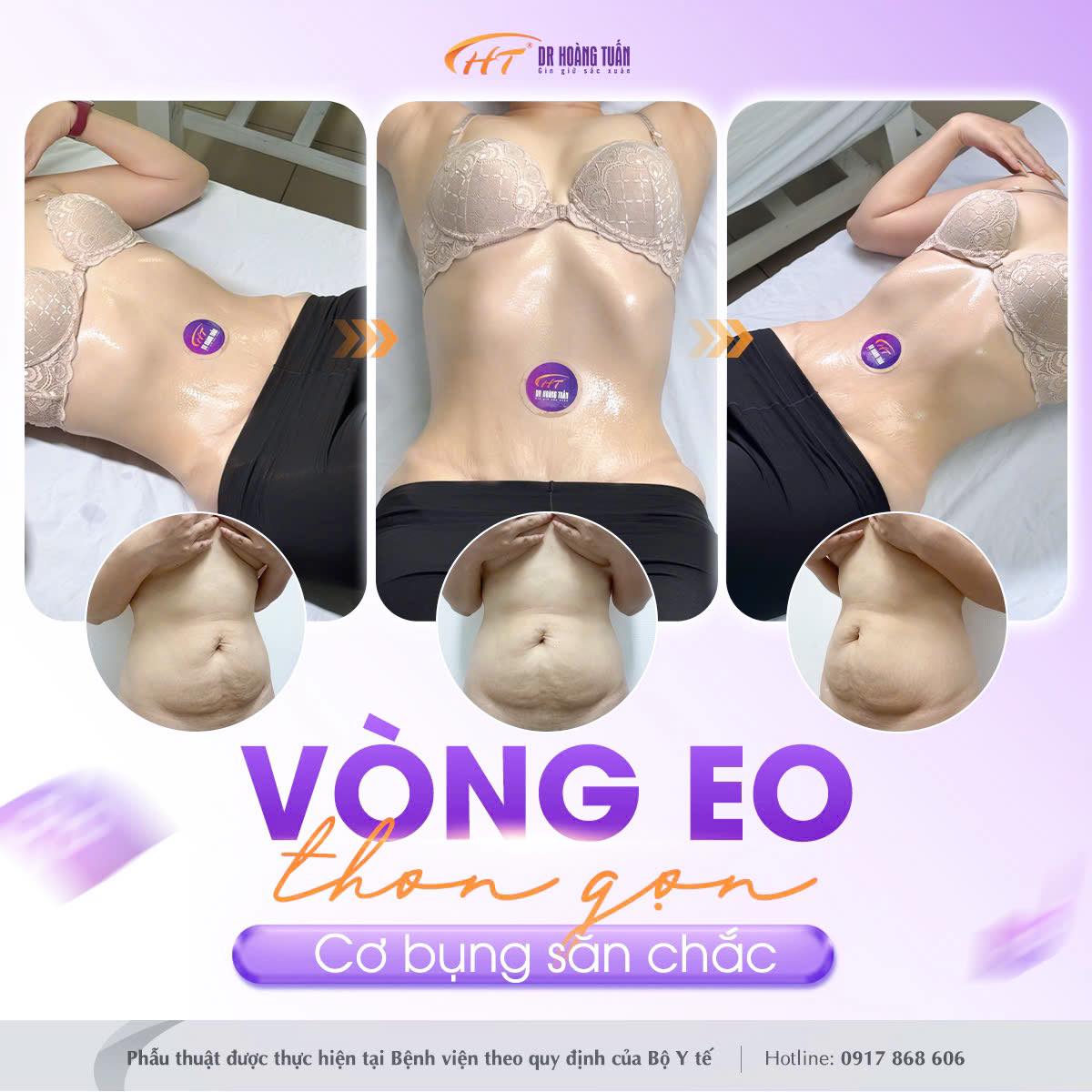 h&uacute;t mỡ tạo h&igrave;nh bụng c&oacute; đau kh&ocirc;ng