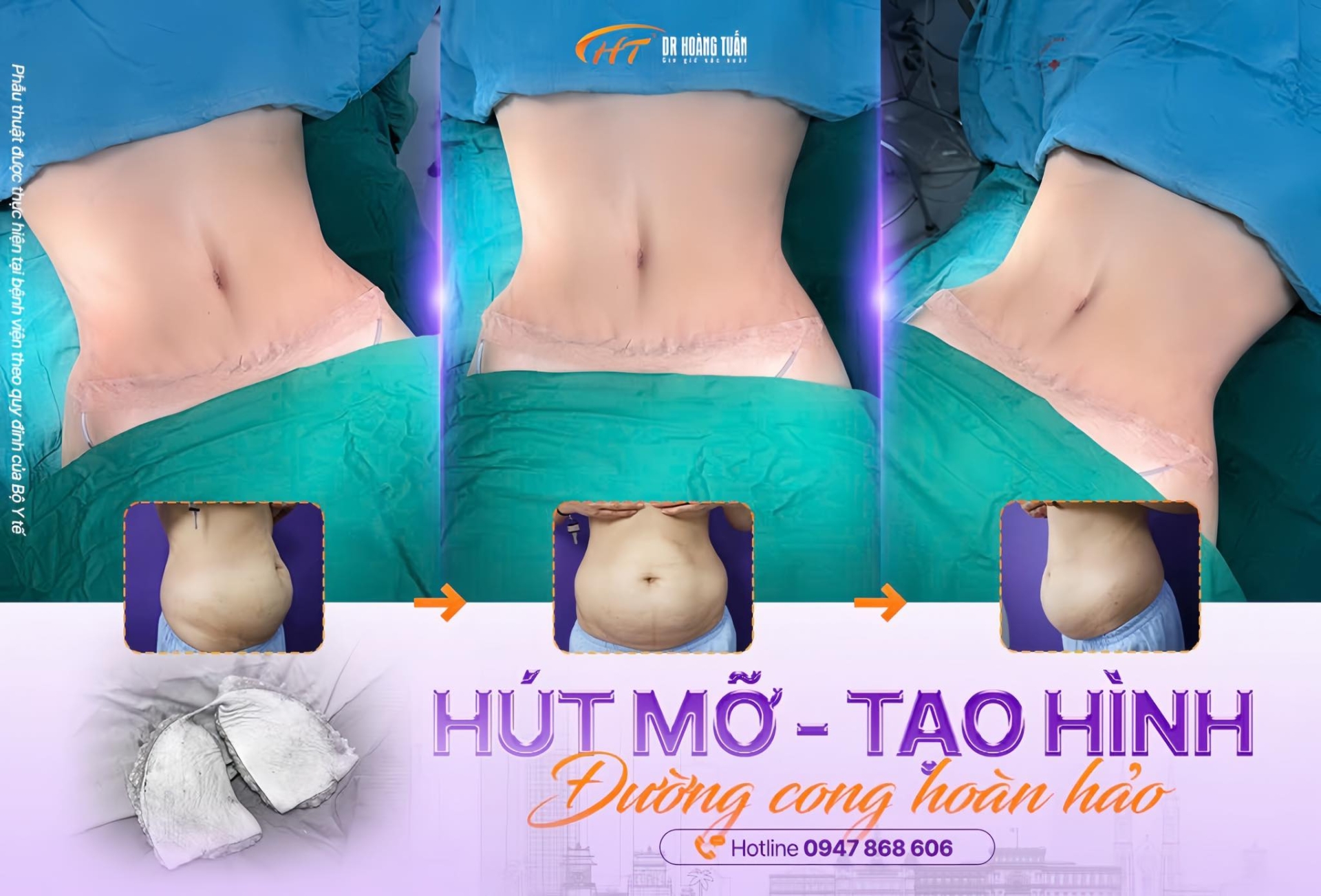 hút mỡ bụng bao lâu thì hết sưng