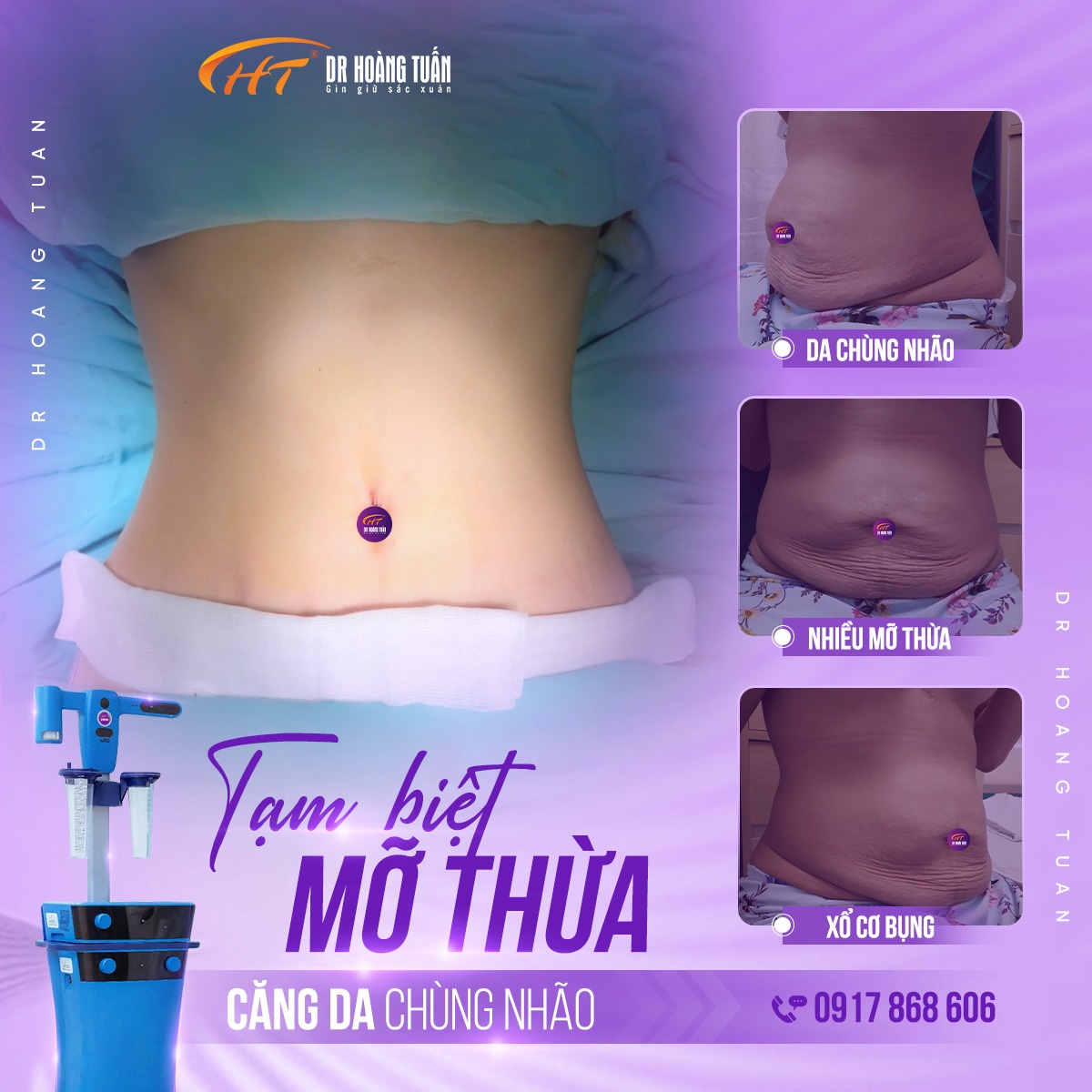 hút mỡ có làm da bị lồi lõm không