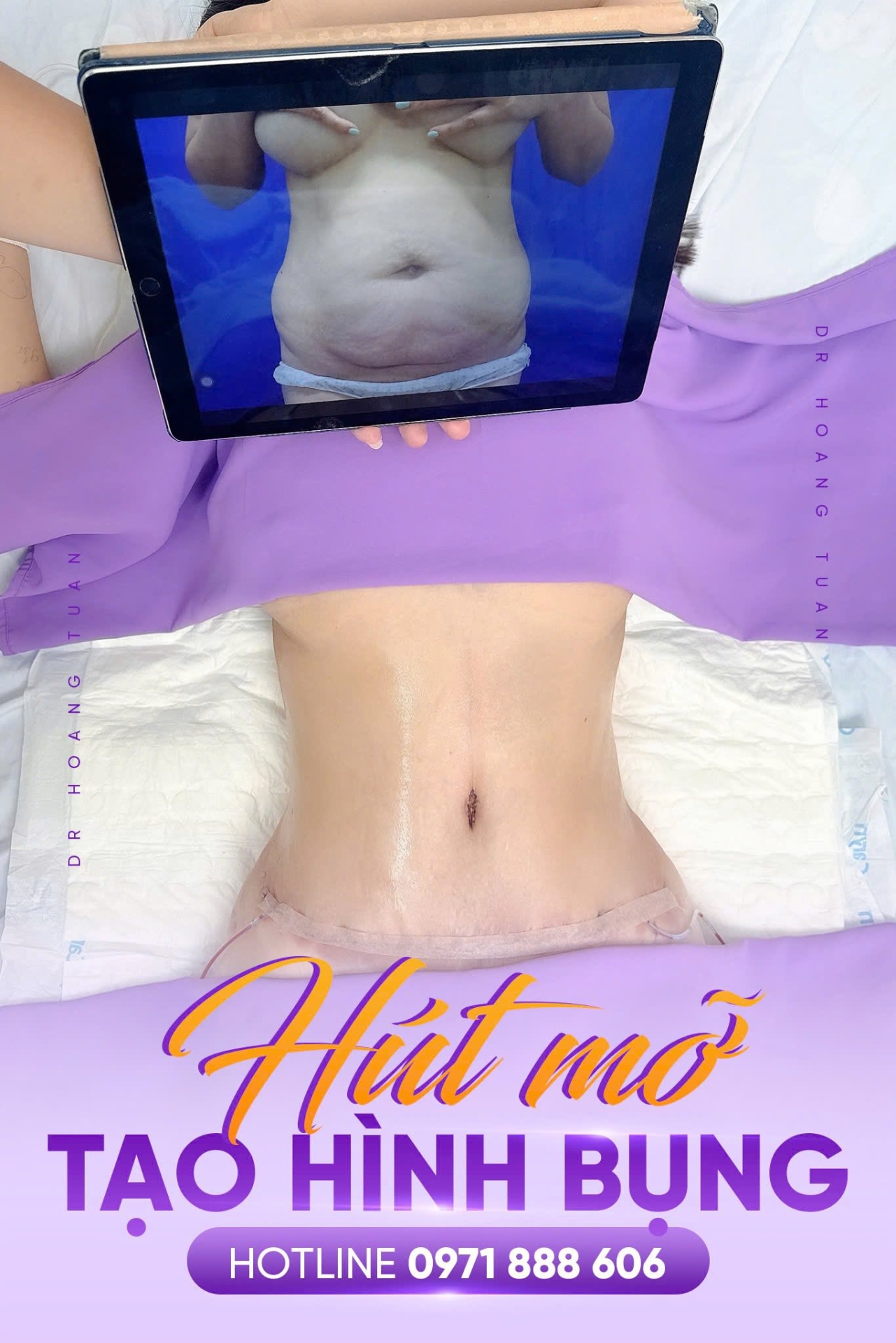 h&uacute;t mỡ tạo h&igrave;nh bụng nguy hiểm kh&ocirc;ng