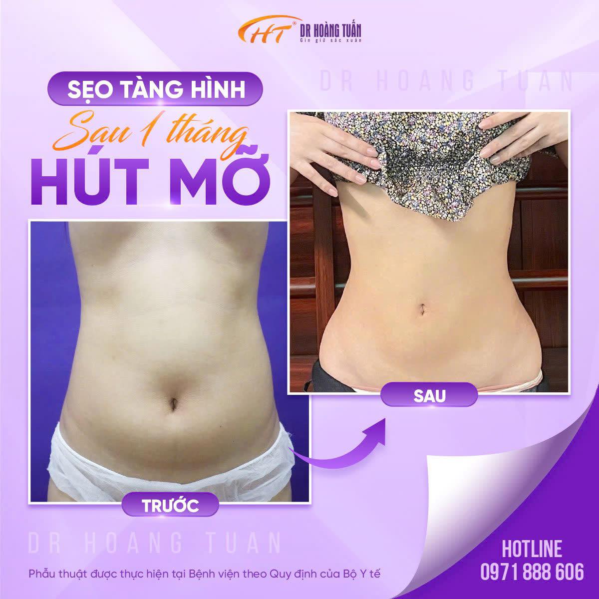 hút mỡ bụng bao lâu thì hết sưng