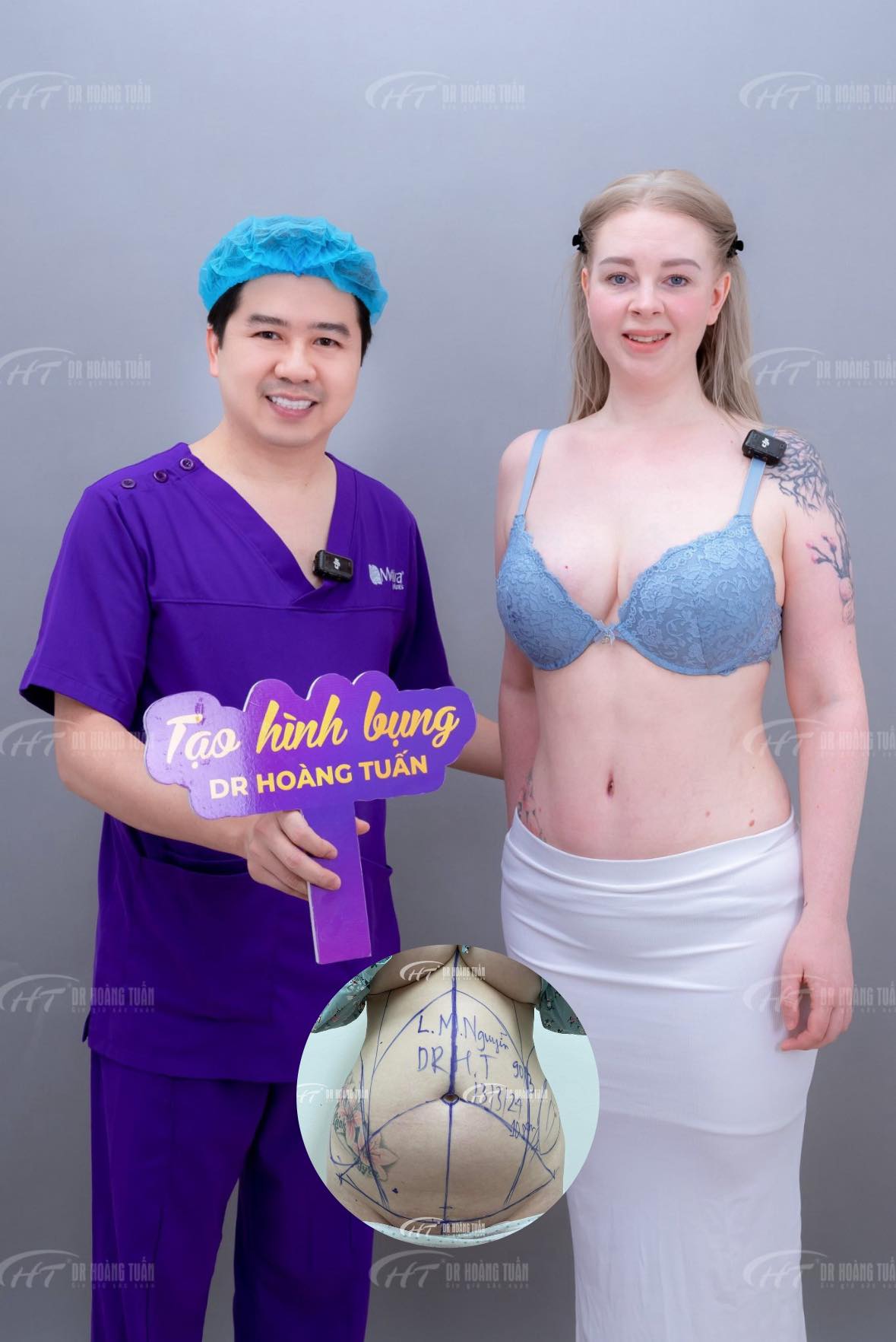 h&uacute;t mỡ bụng kh&ocirc;ng phẫu thuật l&agrave; g&igrave;