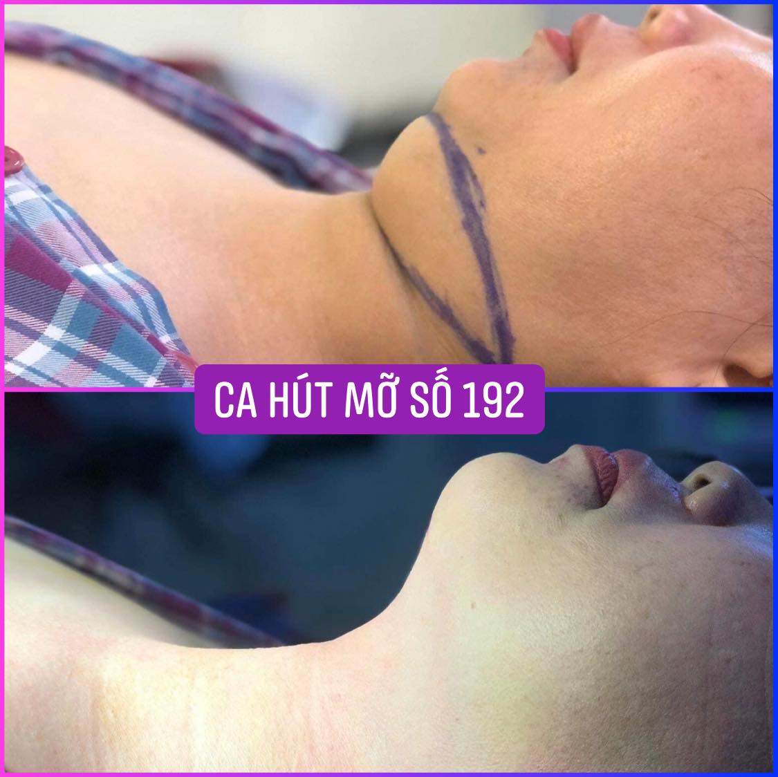 hút mỡ nọng cằm