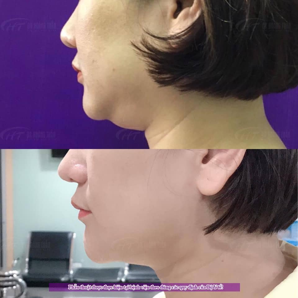 hút mỡ nọng cằm