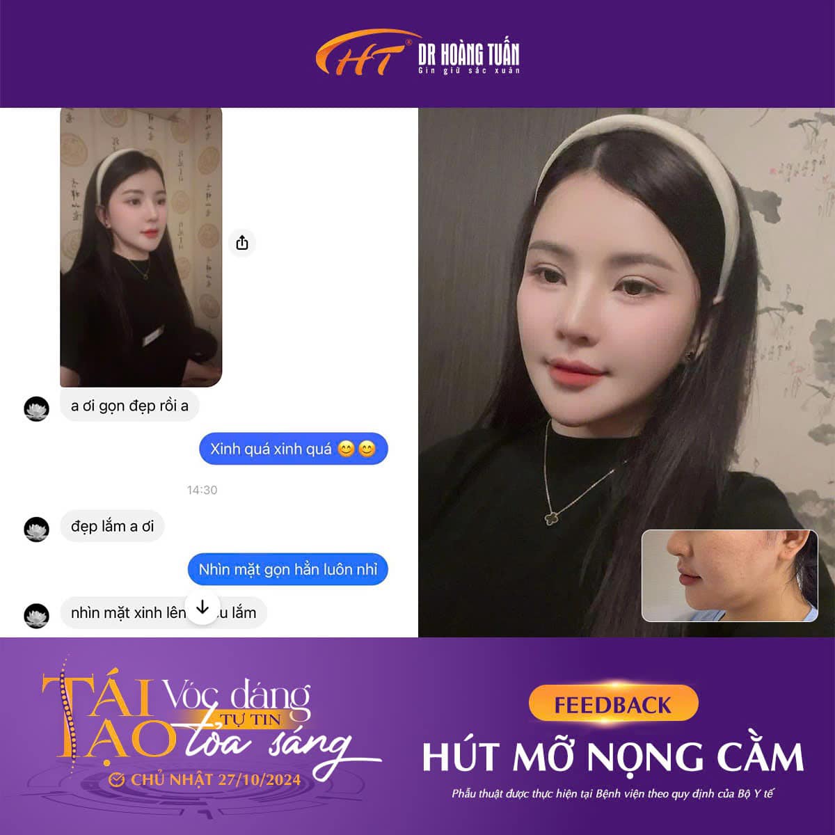 hút mỡ nọng cằm