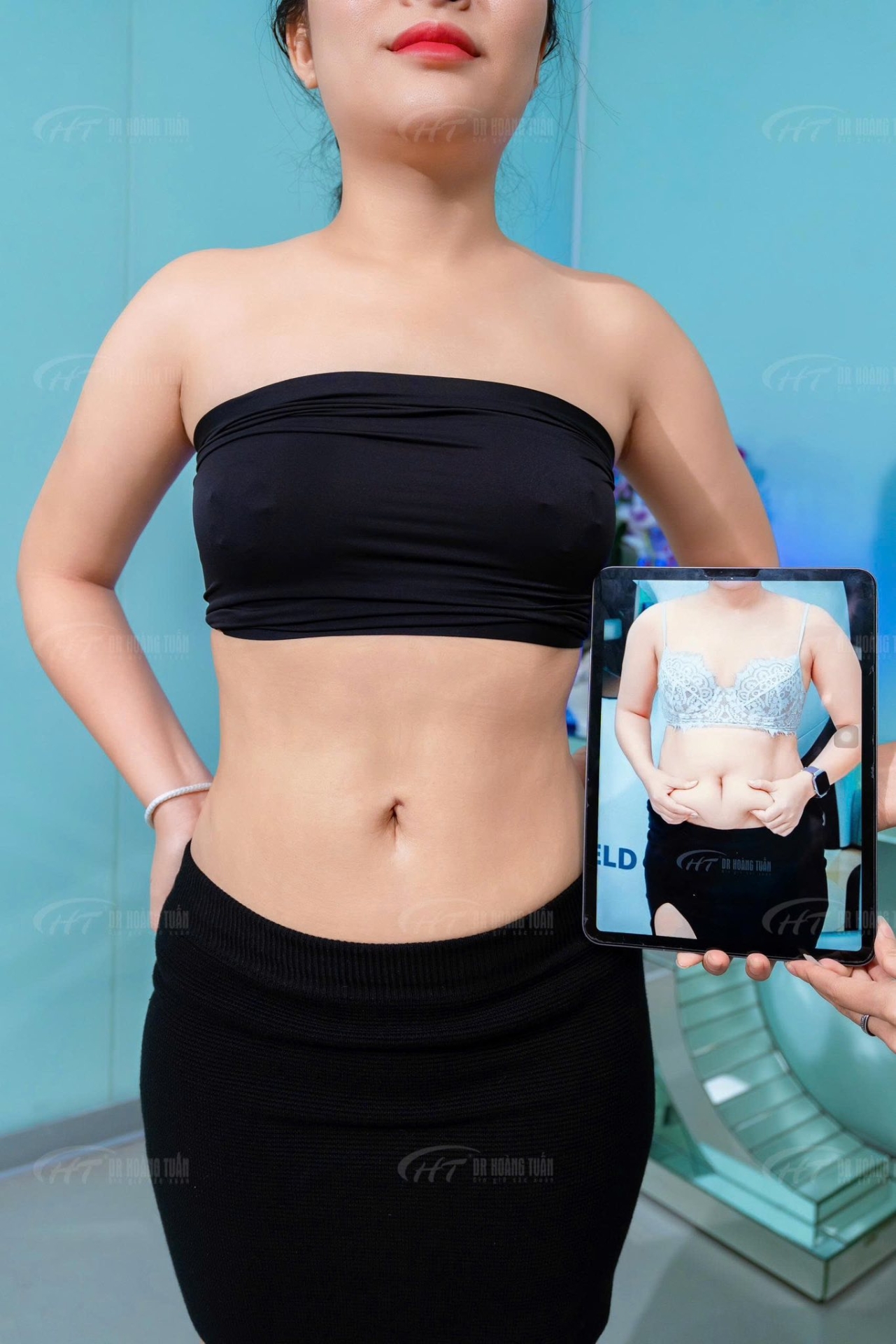 h&uacute;t mỡ bụng kh&ocirc;ng phẫu thuật l&agrave; g&igrave;