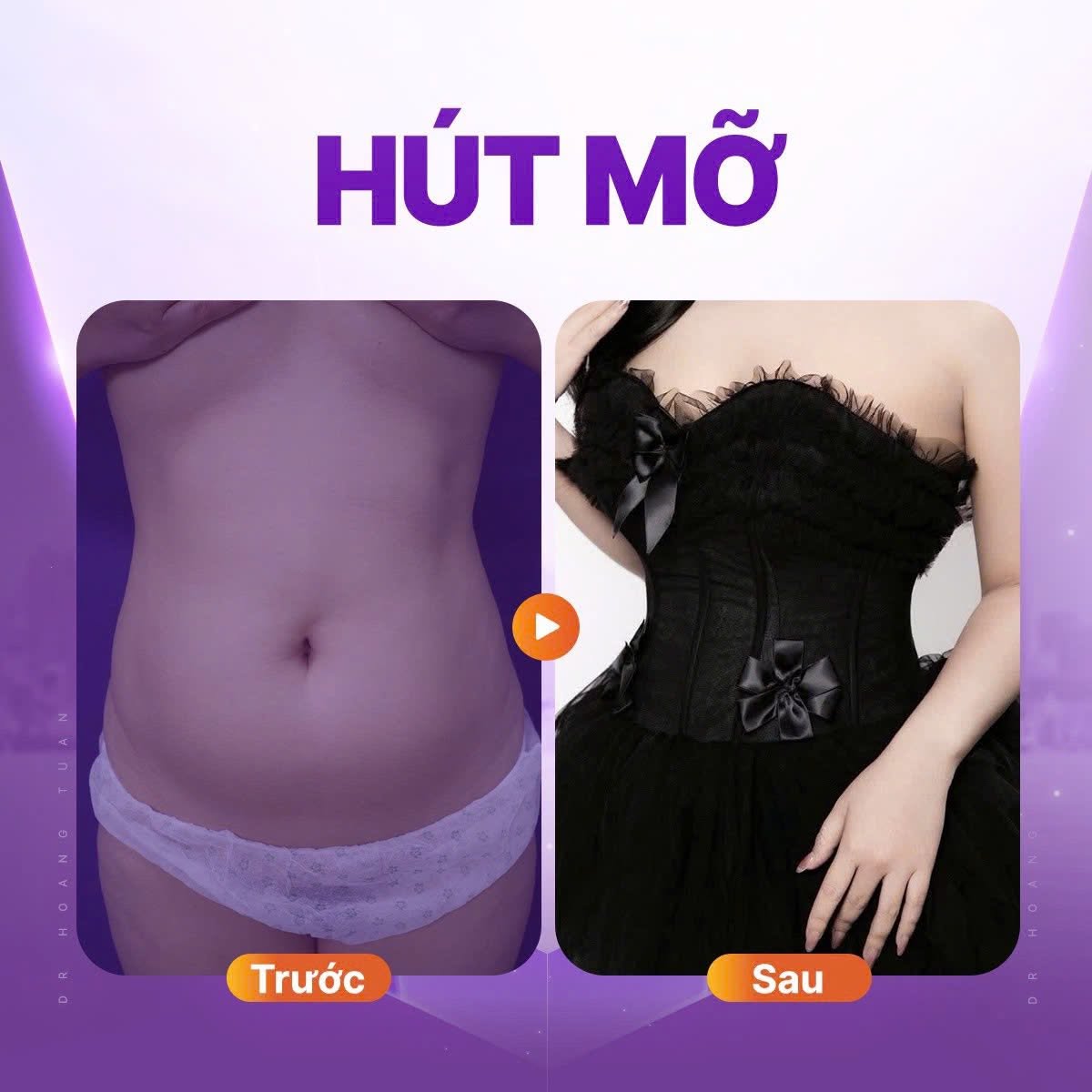 Hút mỡ bụng có bị béo lại không?