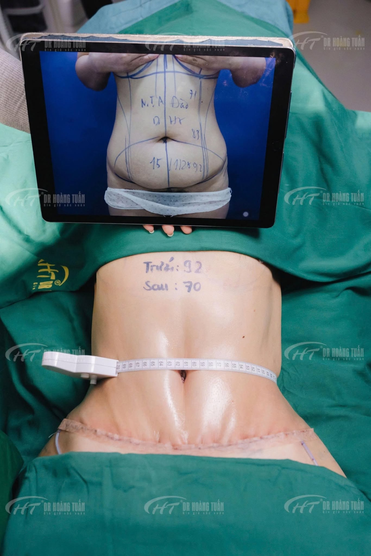 Hút mỡ bụng có bị béo lại không?