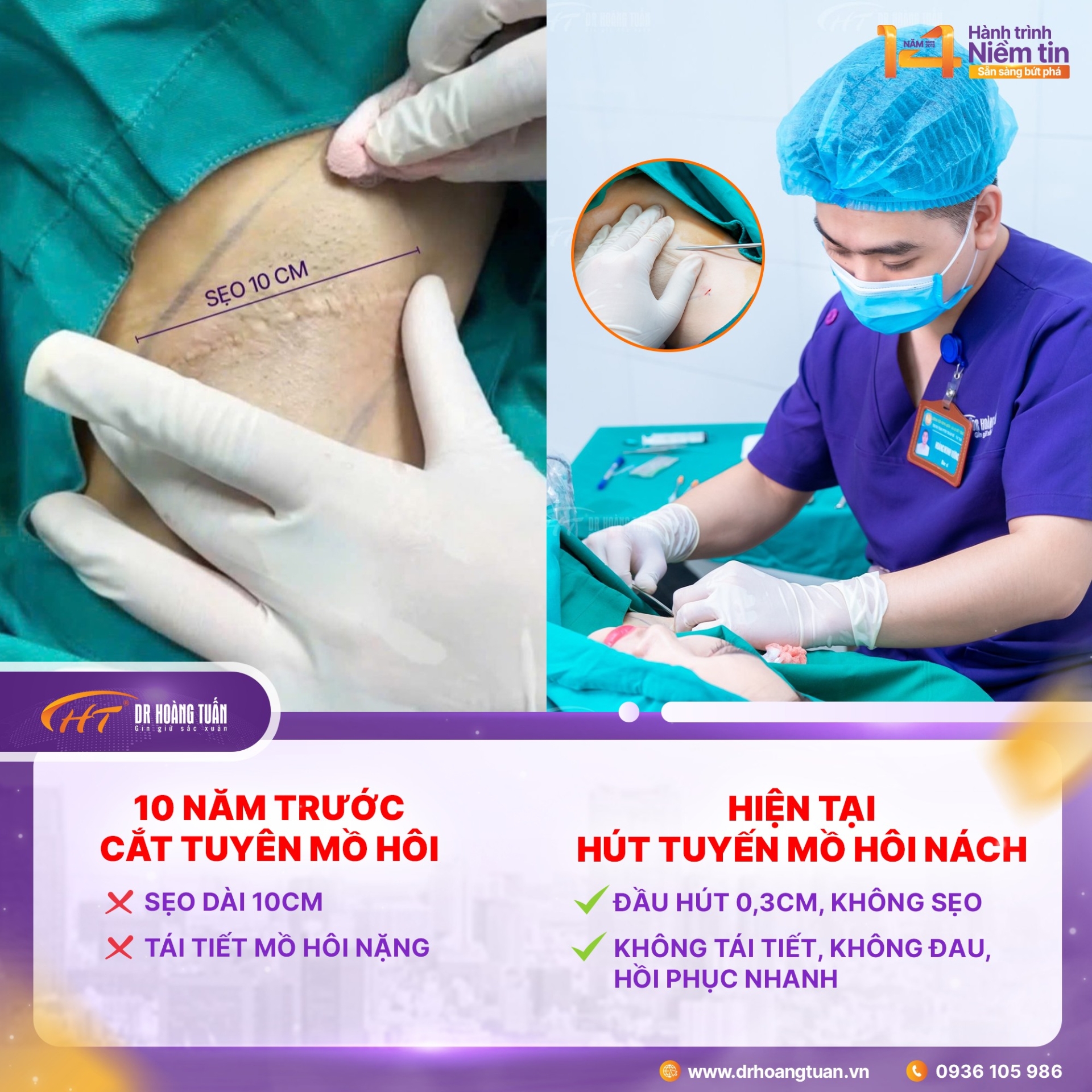 h&uacute;t tuyến mồ h&ocirc;i n&aacute;ch c&oacute; hiệu quả kh&ocirc;ng
