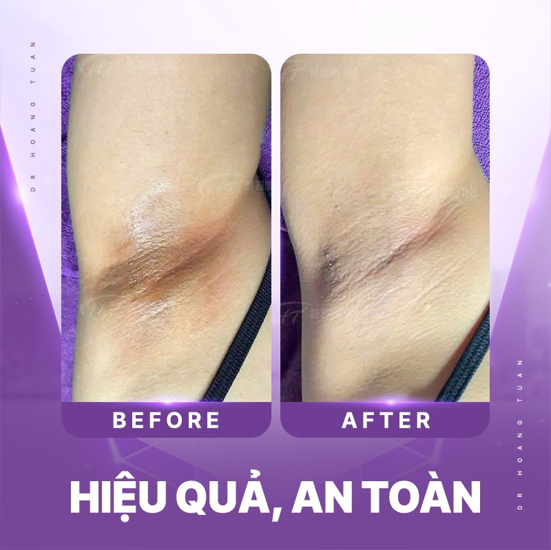 h&uacute;t tuyến mồ h&ocirc;i n&aacute;ch c&oacute; đau kh&ocirc;ng