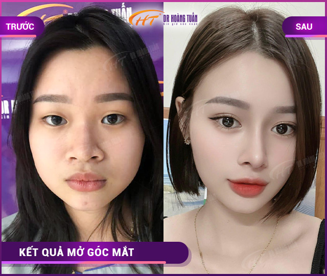 các phương pháp phẫu thuật thẩm mỹ mắt