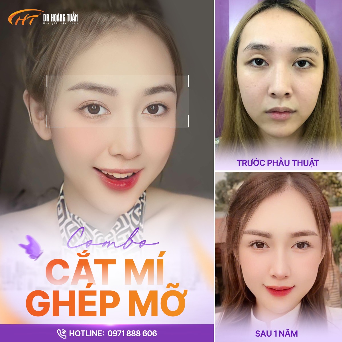 làm đầy hốc mắt bằng mỡ tự thân
