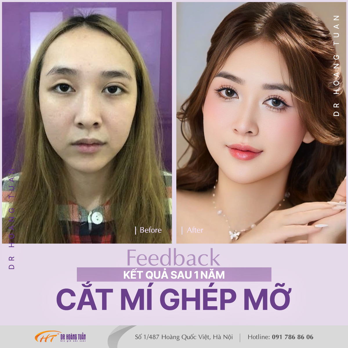 làm đầy hốc mắt bằng mỡ tự thân