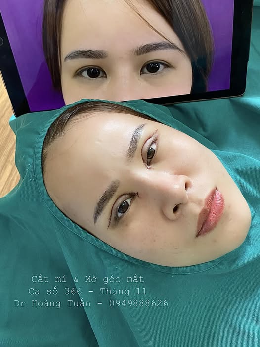 mở g&oacute;c mắt bao l&acirc;u th&igrave; hết sưng