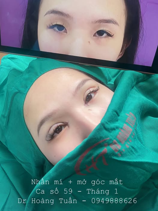 mở góc mắt trong có tác dụng gì
