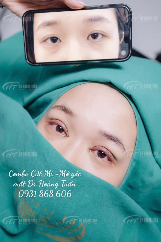 mở g&oacute;c mắt bao l&acirc;u th&igrave; hết sưng