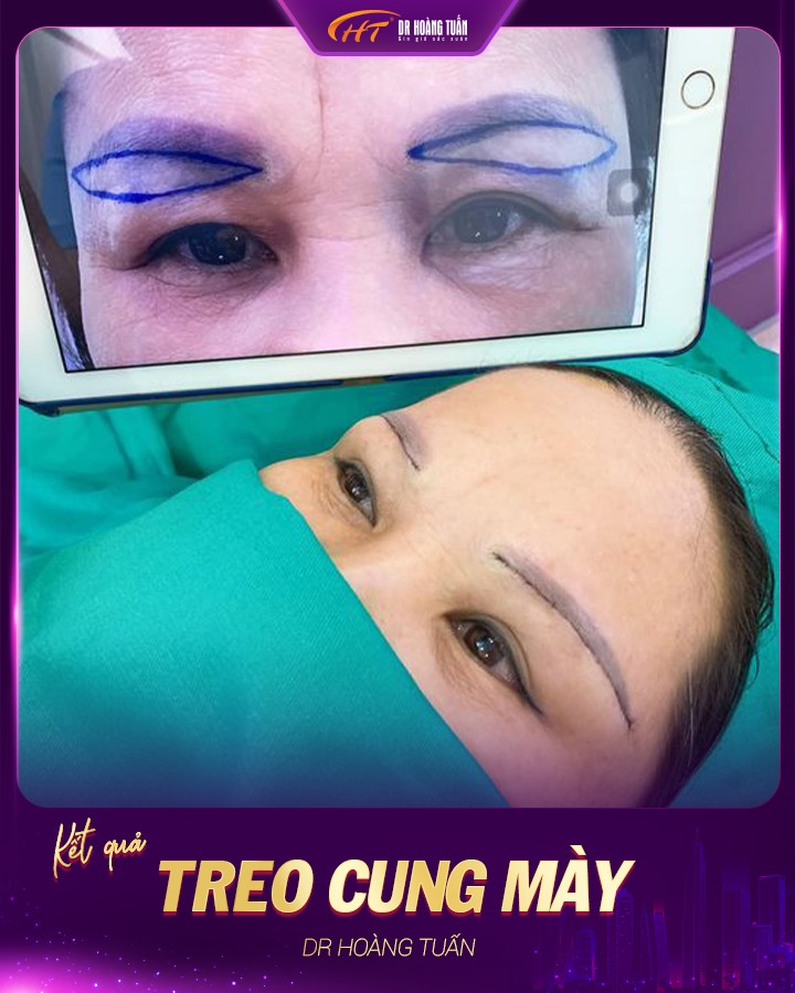 các phương pháp phẫu thuật thẩm mỹ mắt