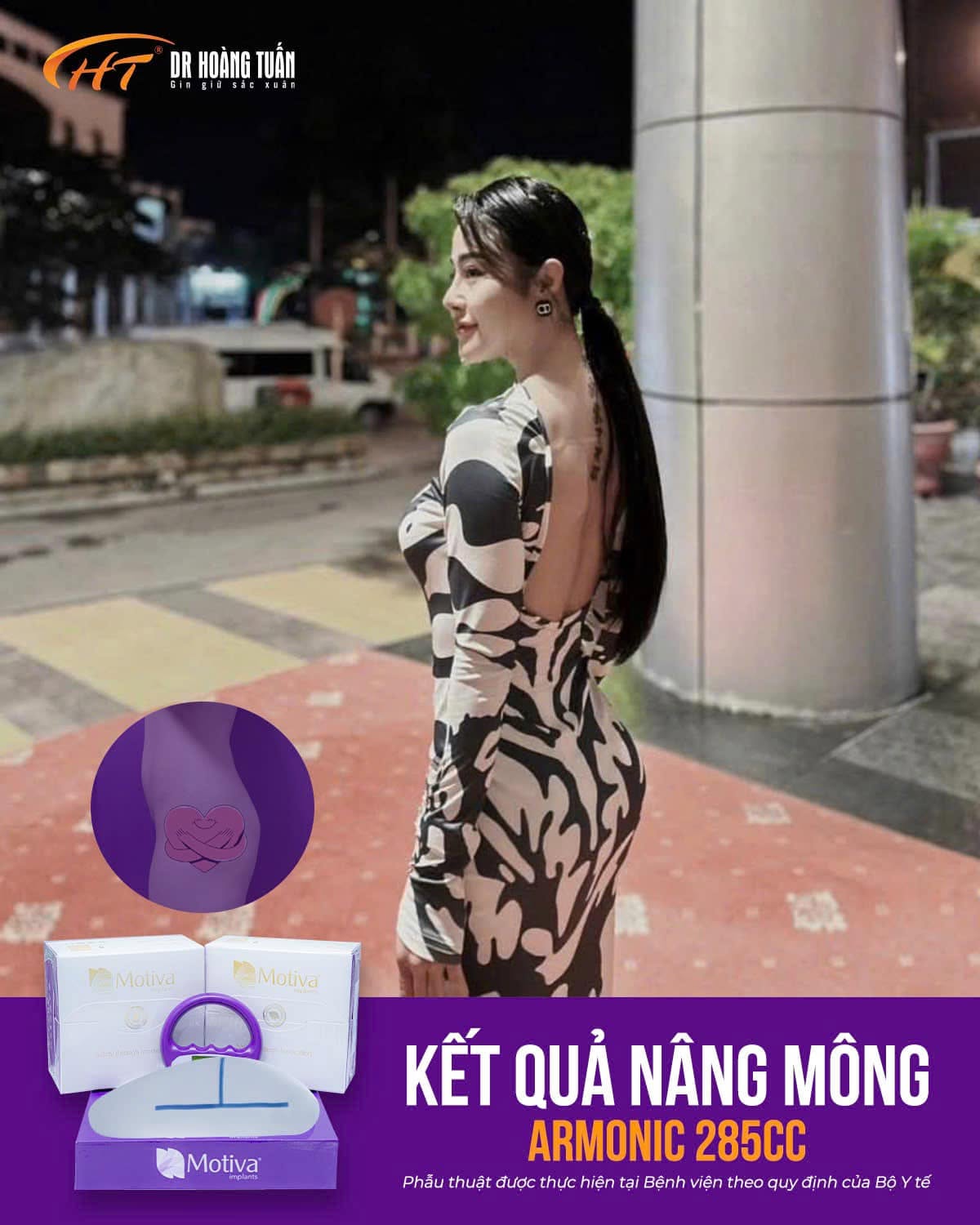 Nâng mông có đau không