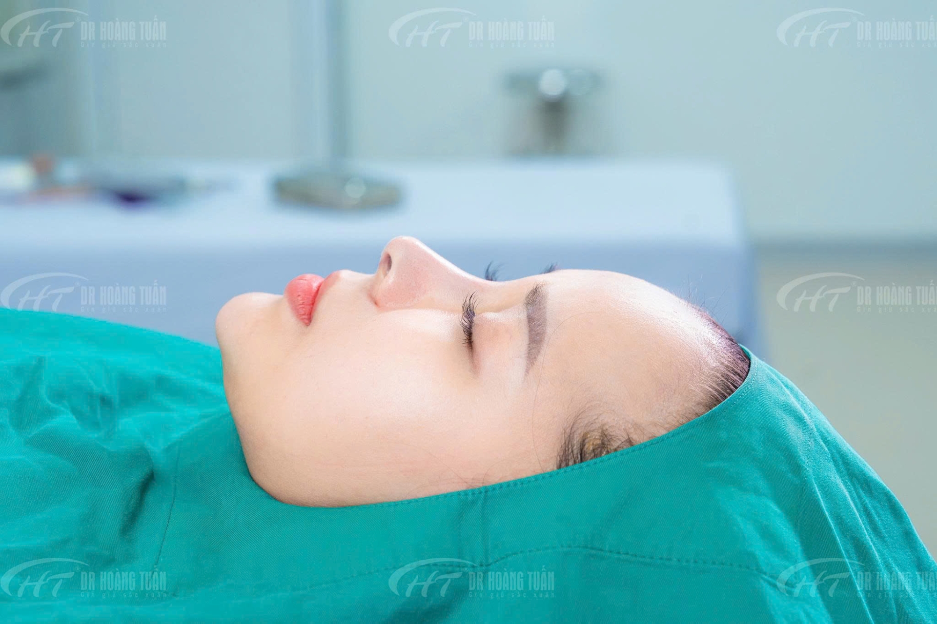 n&acirc;ng mũi sau 1 th&aacute;ng bị sưng