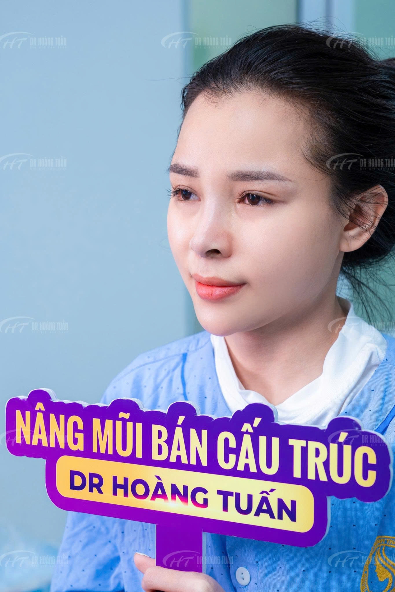 nâng mũi có mất lộc không