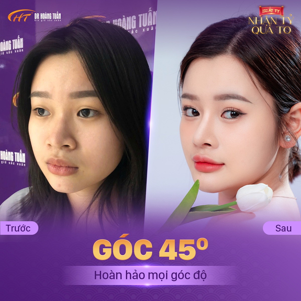 nâng mũi có mất lộc không