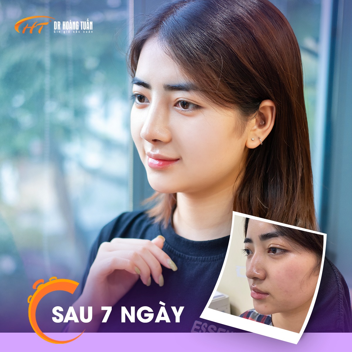 đi làm sau khi nâng mũi có ảnh hưởng không