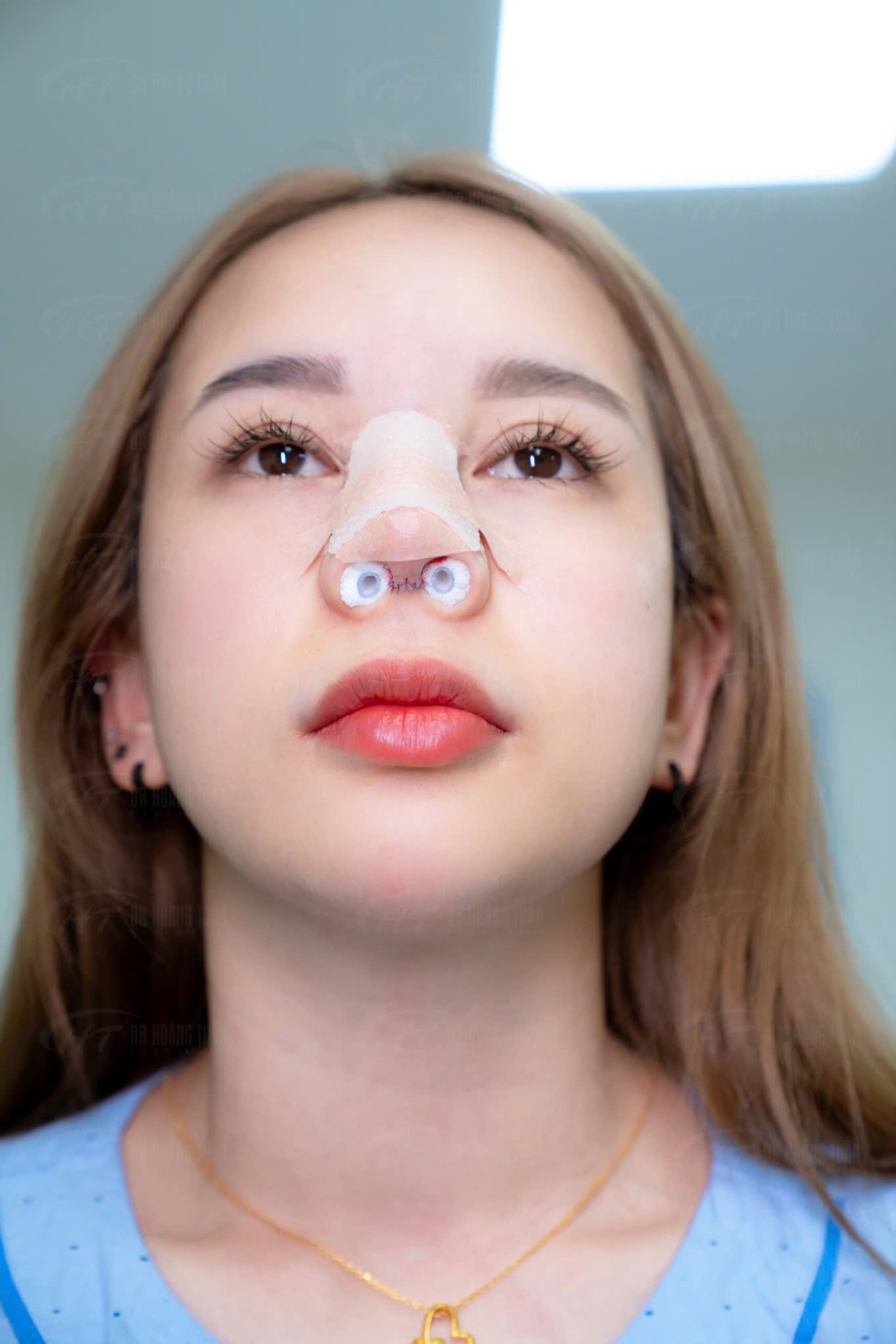 tại sao nâng mũi không được đeo kính