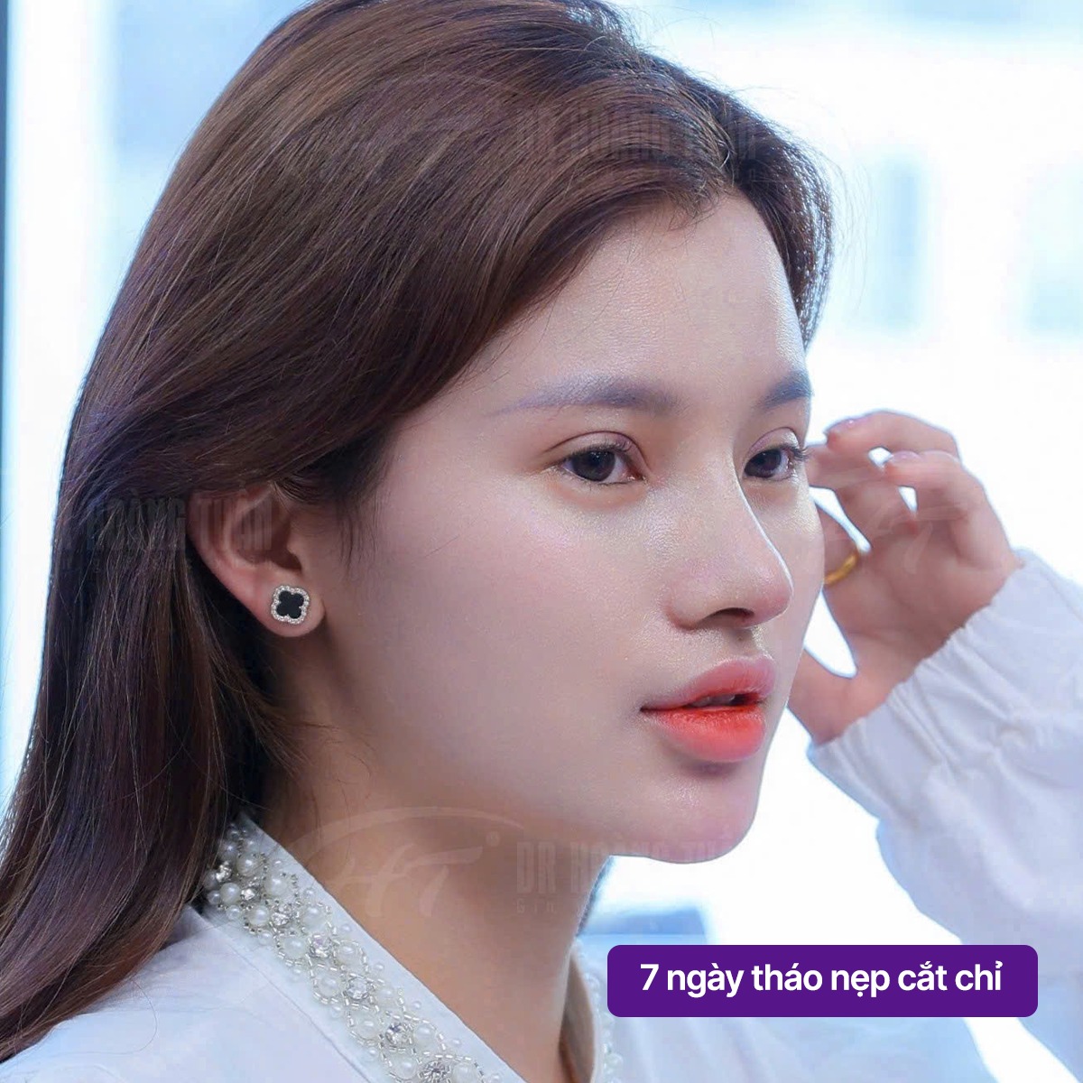 đi làm sau khi nâng mũi có ảnh hưởng không