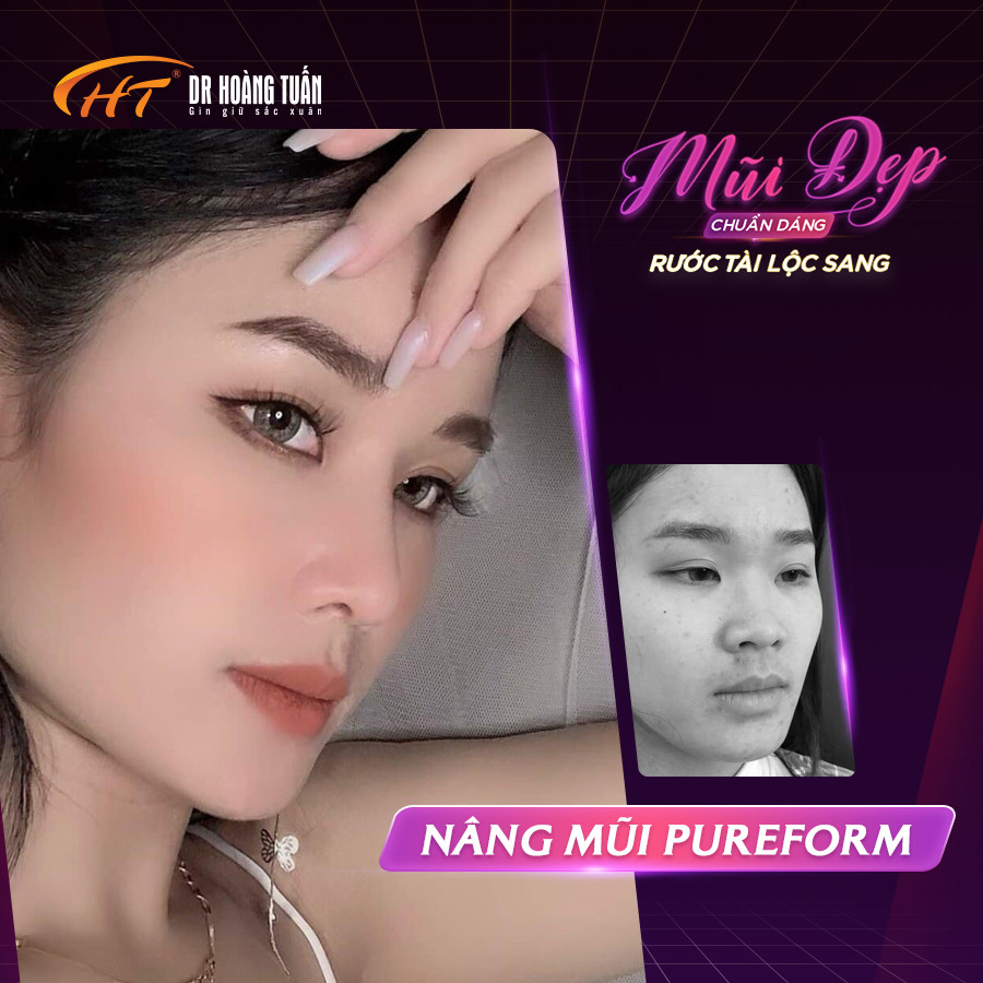 n&acirc;ng mũi mất bao l&acirc;u để hồi phục