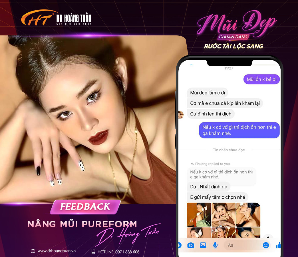 nâng mũi bọc sụn có vĩnh viễn không