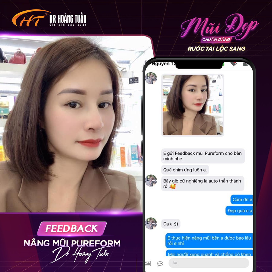 nâng mũi bọc sụn có vĩnh viễn không