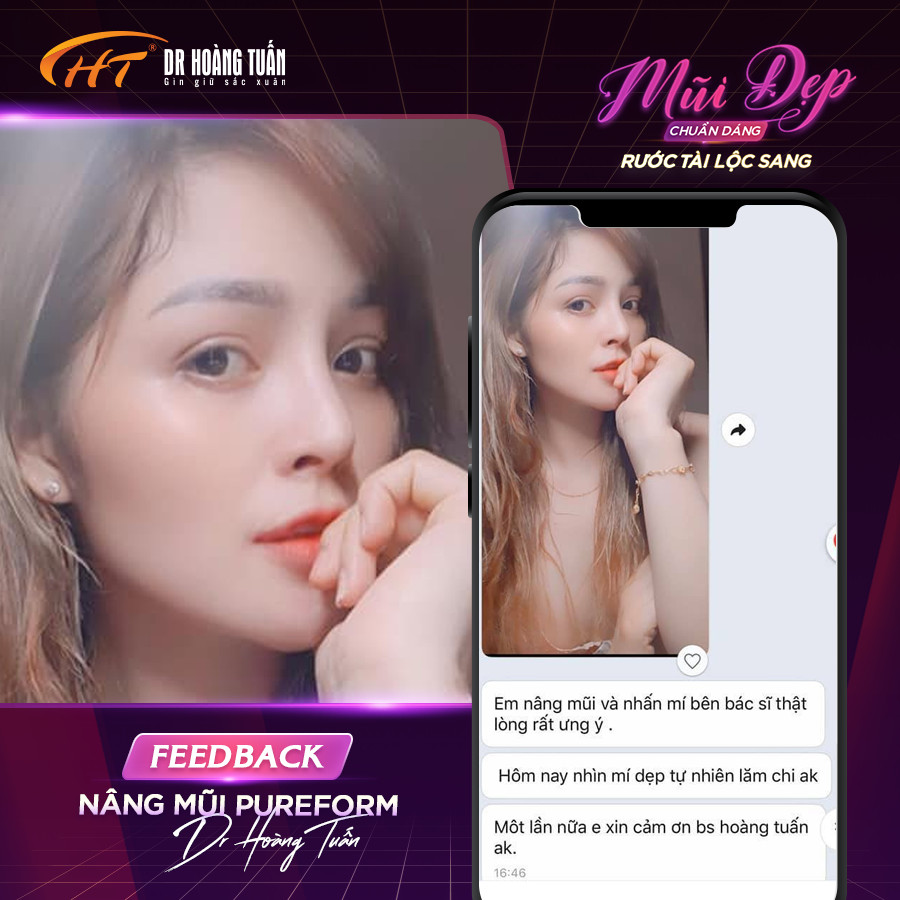 nâng mũi bọc sụn có vĩnh viễn không