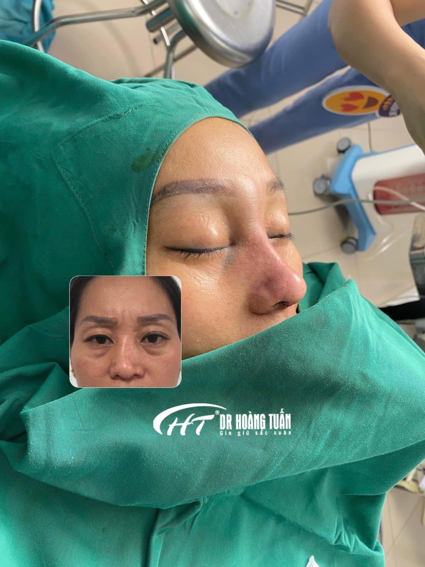 n&acirc;ng mũi bị lệch