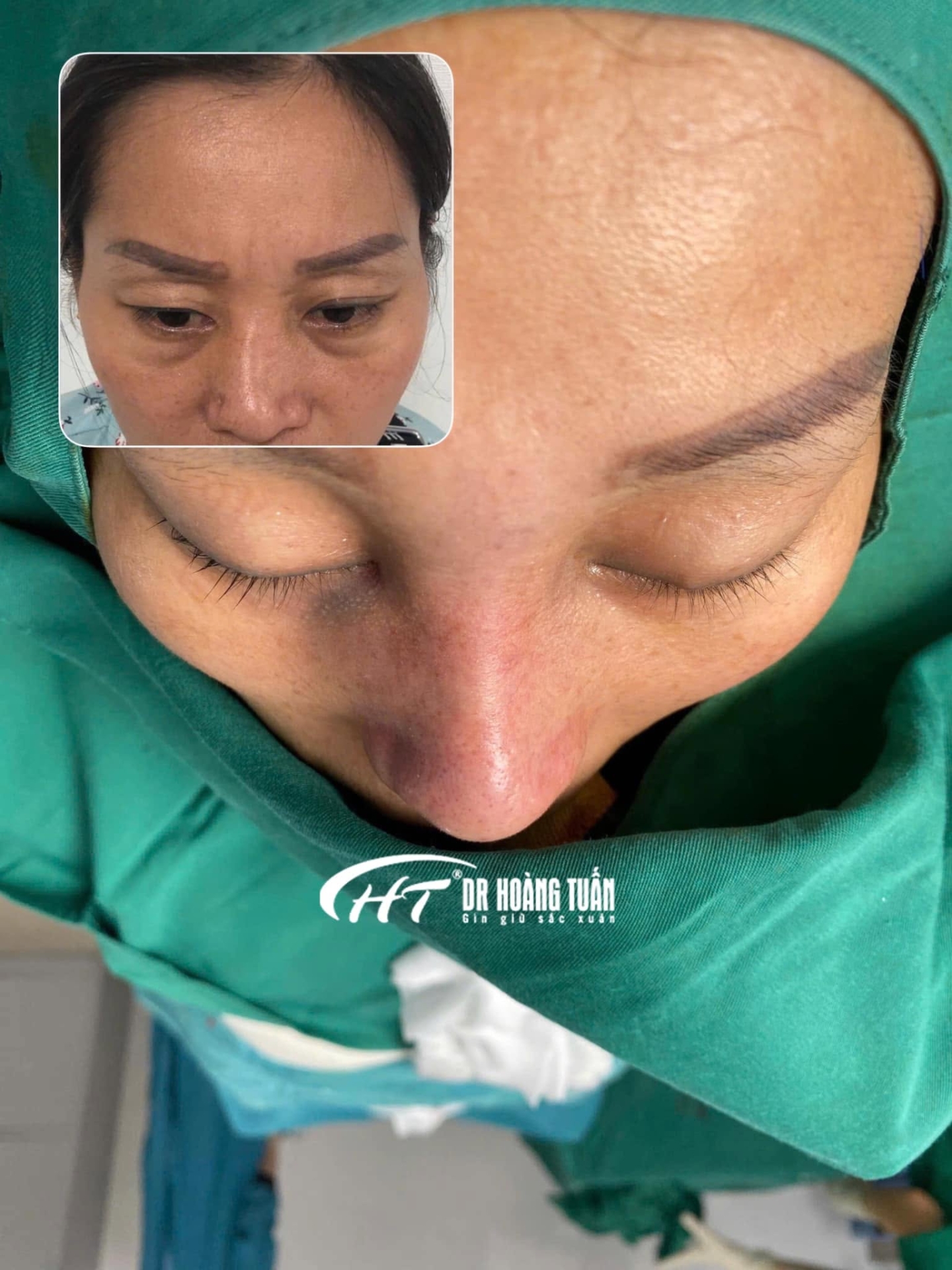 n&acirc;ng mũi bị lệch