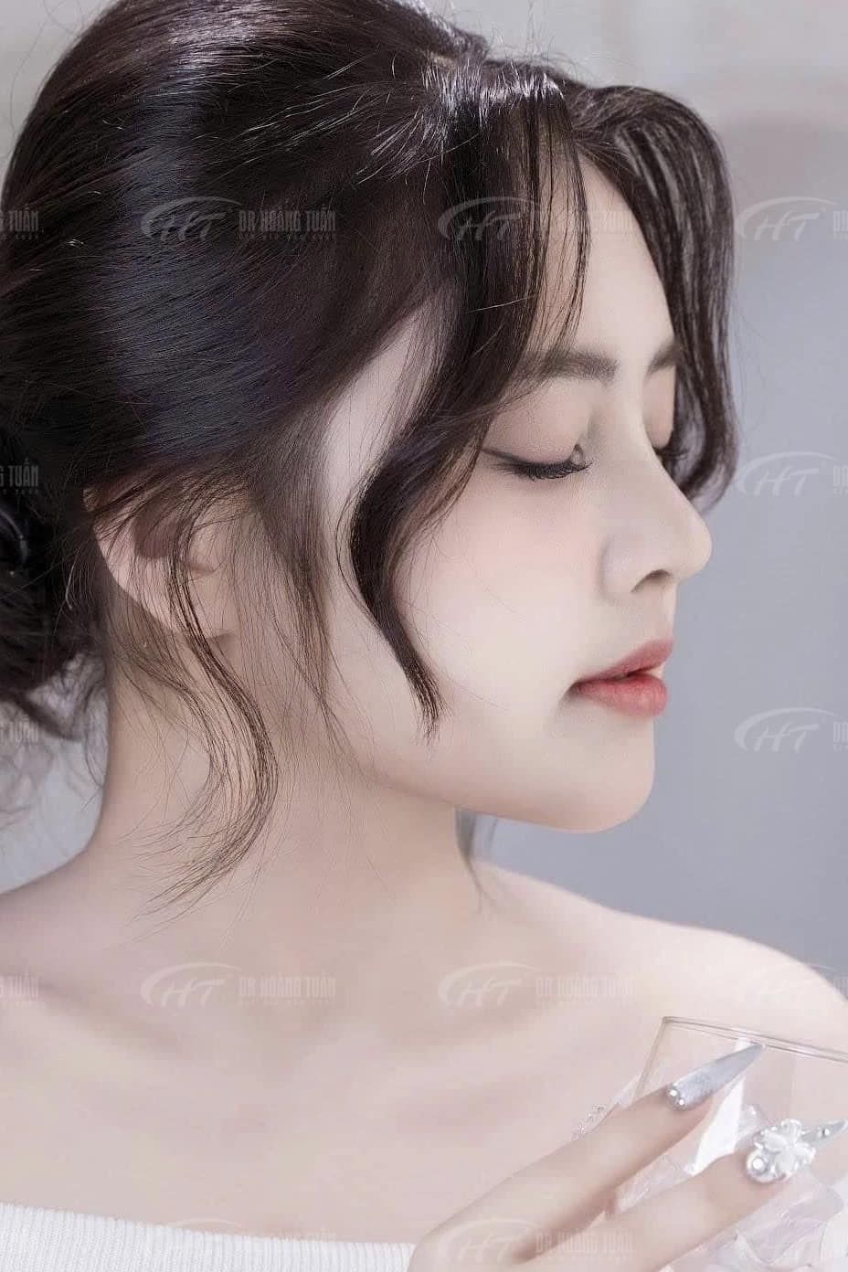 viêm xoang có nâng mũi được không