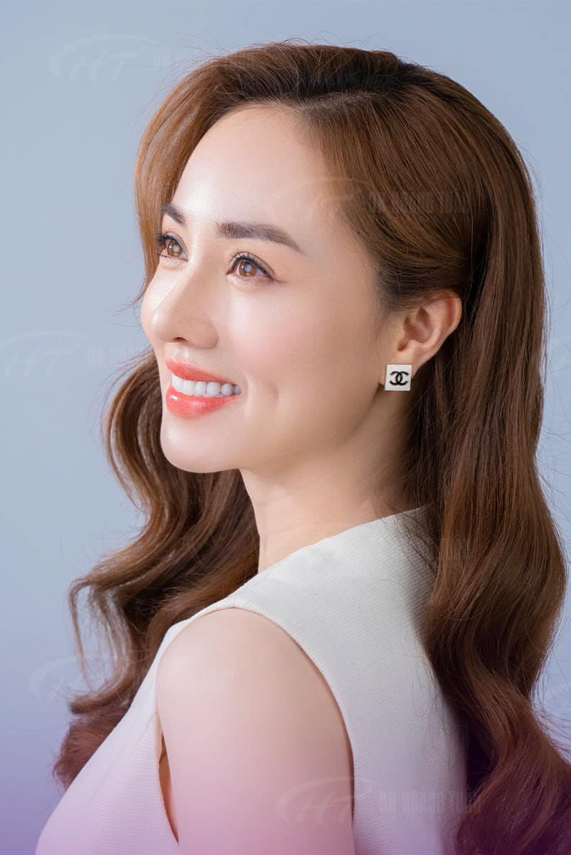 nâng mũi bao lâu thì đầu mũi hết to